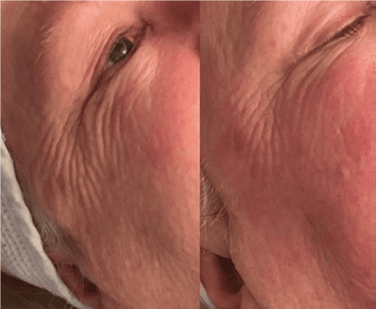 Geneo-RF-Facial-Skin-Tightening-Before-After