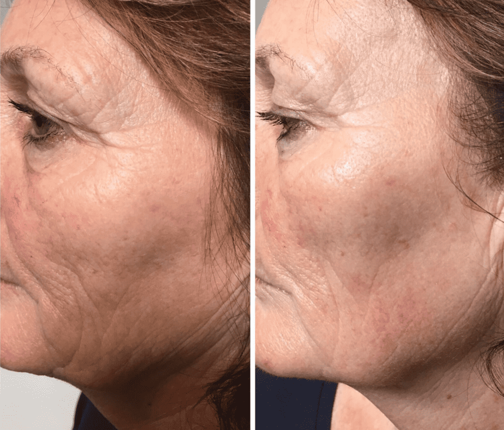 Geneo-Radio-Frequency-Facial-Before-After-1024x874