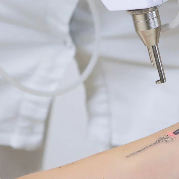 LASERNDYAGELIMINACIONDETATUAJES_0df8e832-b849-40ea-adf9-49cee48d5a55