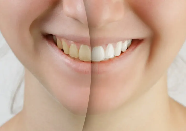 antes-despues-blanqueamiento-dental-768x541