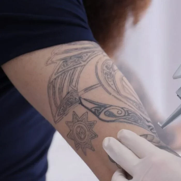 eliminar-tatuajes-1024x922