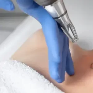 img_eliminacion_de_tatuajes_4
