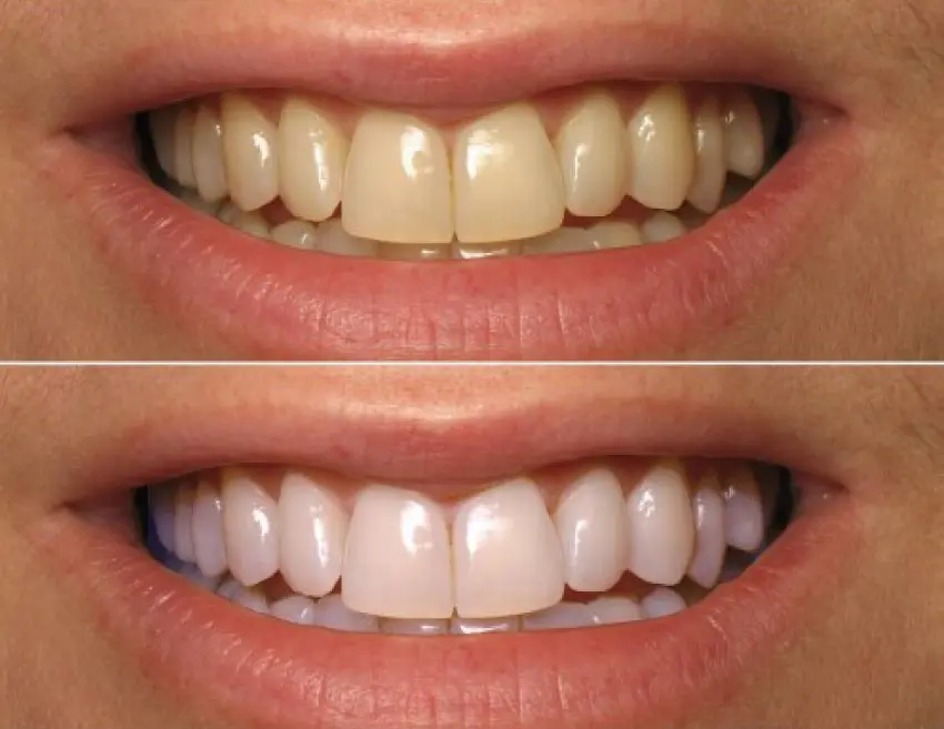 seguros-dentales
